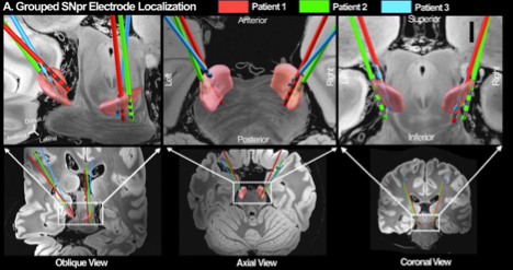 Rewiring Psychosis: How Neuromodulation Is Shifting the Schizophrenia Treatment Paradigm