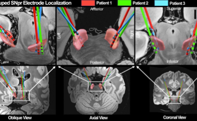 Rewiring Psychosis: How Neuromodulation Is Shifting the Schizophrenia Treatment Paradigm